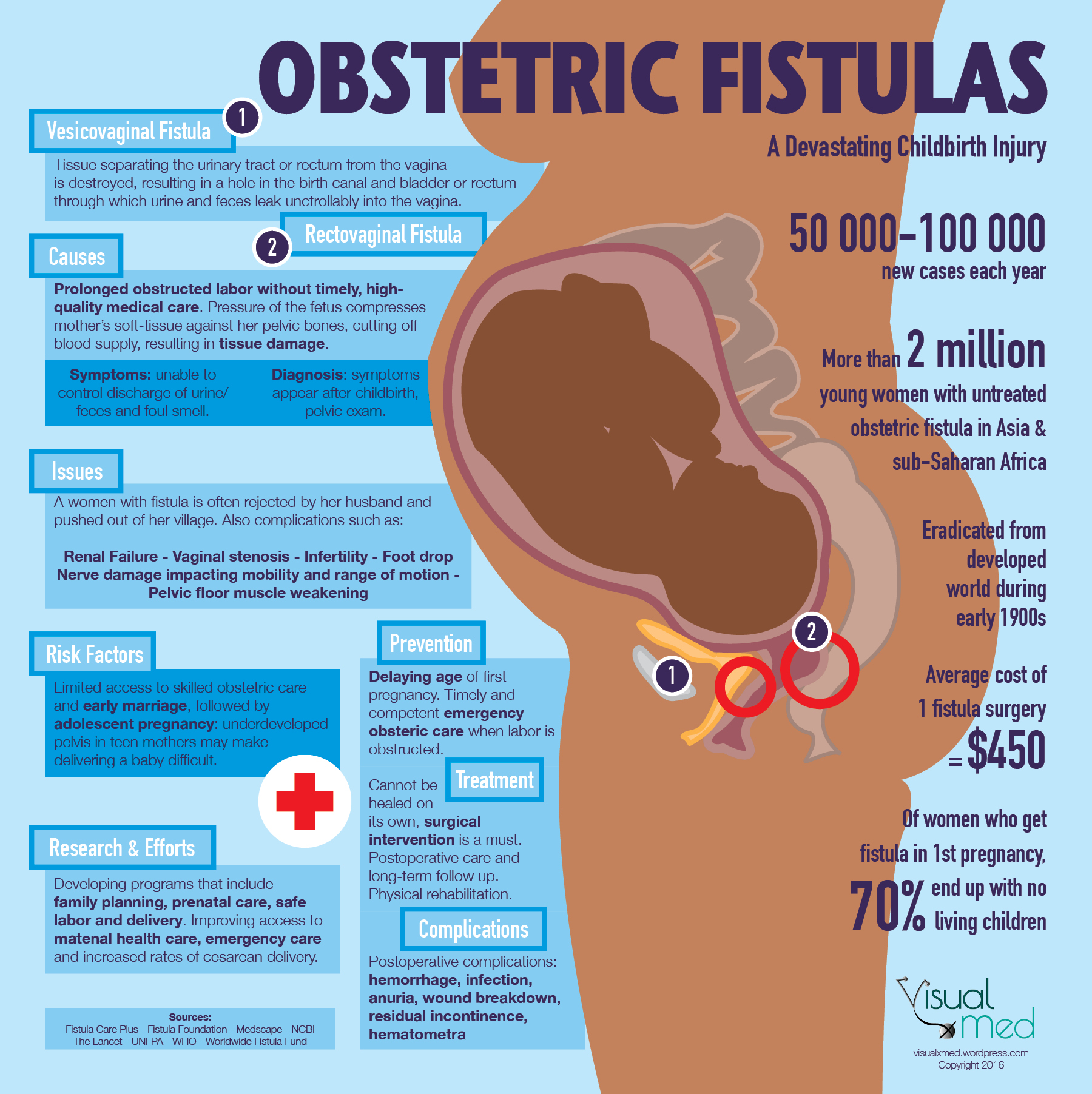 Obstetric Fistula